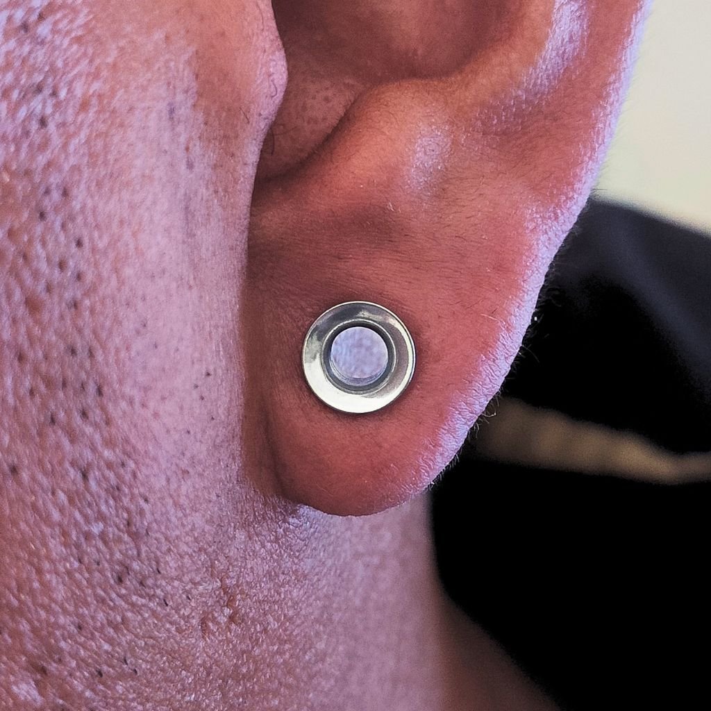 Dilatazione lobe